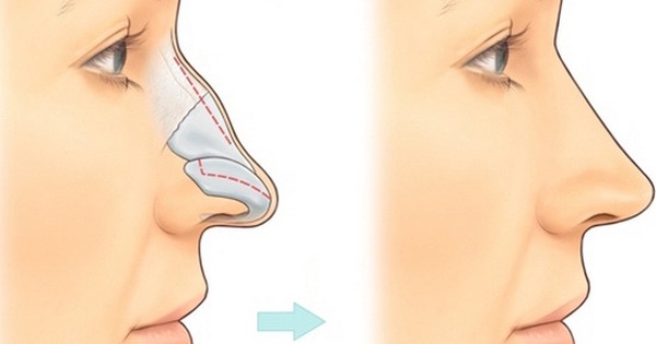 Điều gì gây ra sự gãy xương mũi?
