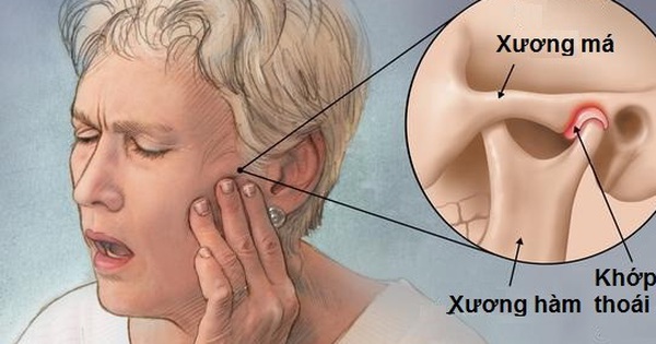 Khớp thái dương là bộ phận nào trong hàm và tại sao viêm khớp nó có thể gây ra các triệu chứng như đau đầu hay chóng mặt?
