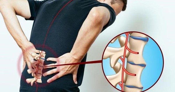 Lợi ích của việc tập trị liệu giảm đau lưng do BS Wynn Huynh hướng dẫn là gì?
