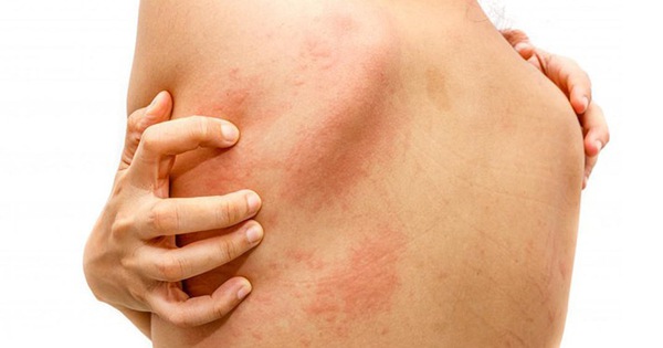 Nhận biết nguyên nhân và khắc phục tình trạng phát ban đỏ trên da