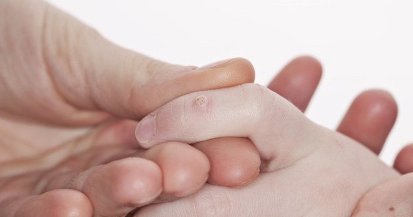 Viêm da do virus hpv gây mụn cóc và cách chăm sóc sức khỏe