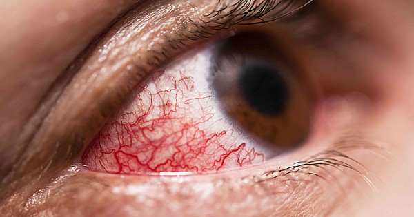 Thành phần chính của thuốc nhỏ mắt viêm màng bồ đào là gì?
