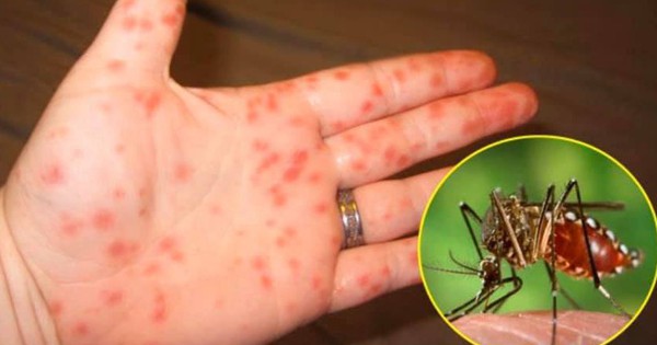 Sự liên quan giữa sốt xuất huyết và sốt Dengue?
