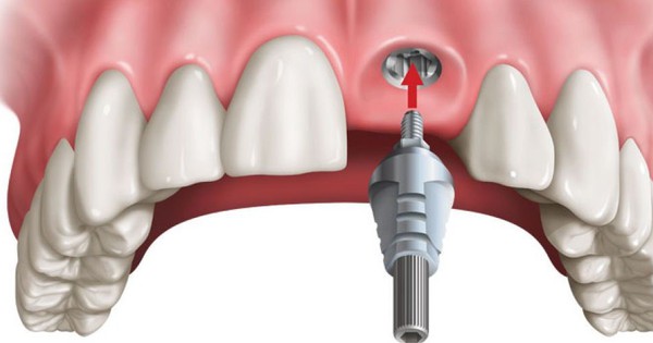 thumbnail - Những nguy cơ gây mất an toàn khi trồng răng implant hàm trên