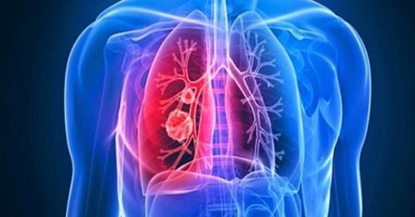 Cách sử dụng thuốc ức chế miễn dịch để điều trị xơ phổi tự phát?
