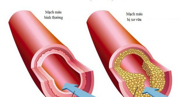 Phòng tránh bệnh xơ vữa đông mạch vành như thế nào?