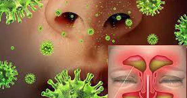 Viêm xoang có liên quan đến vi khuẩn gây nhiễm trùng không?
