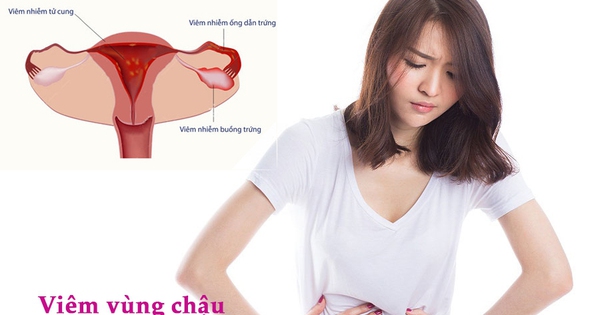 Điều trị viêm vùng chậu như thế nào? 
