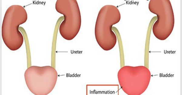 Tại sao việc đi tiểu thường xuyên là một phương pháp điều trị quan trọng cho viêm bàng quang mạn tính?
