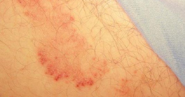 Làm thế nào để chẩn đoán nấm da háng?
