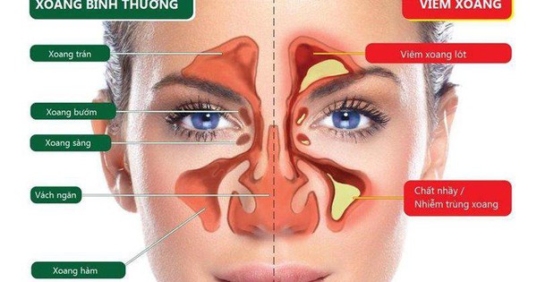 Có những phân loại nào của viêm xoang hàm trên?
