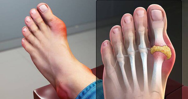 Nếu có đau ngón chân cái, có nên tự điều trị tại nhà hay nên đi khám bác sĩ?

