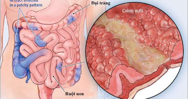 Có thuốc nào mới nhất hiện nay để điều trị bệnh Crohn?
