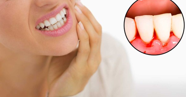 Thuốc trị chảy máu chân răng nào là phổ biến nhất?
