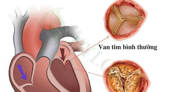 Vôi hóa van tim là hiện tượng gì và tại sao nó xảy ra?
