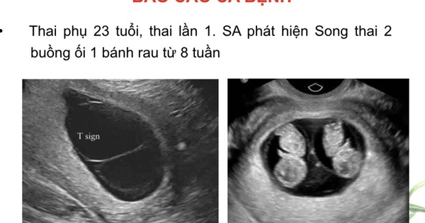 Ca bệnh song thai: Được chẩn đoán sớm bằng siêu âm, Ca bệnh song thai có thể được quản lý và chăm sóc để đảm bảo sự phát triển an toàn cho cả hai bé. Hãy để những hình ảnh này giúp bạn hiểu hơn về căn bệnh này.