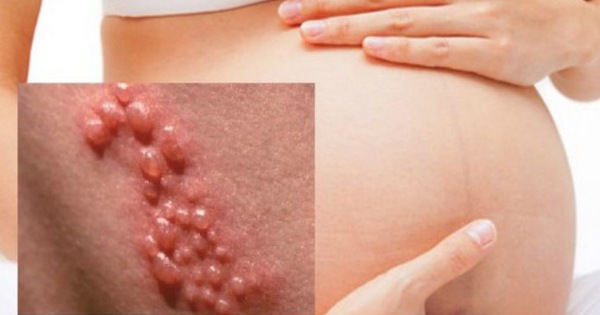Thông tin về bệnh lậu ở phụ nữ mang thai kiểm soát và điều trị hiệu quả
