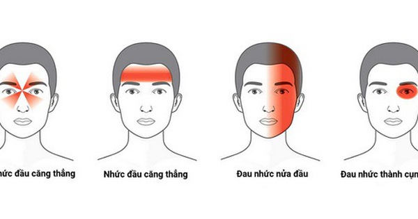 Đau đầu migraine có thể được chẩn đoán như thế nào?
