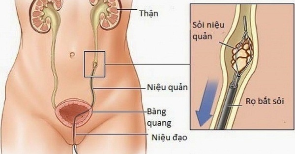 Có những loại sỏi nào không phù hợp để thực hiện quá trình tán sỏi ngoài cơ thể?
