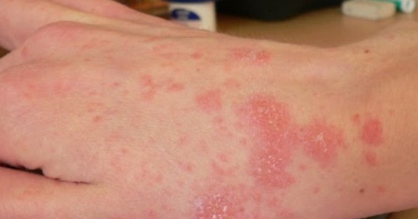 Thuốc 7 màu Silkron được sử dụng để điều trị những vấn đề gì trên da?
