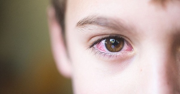 Bệnh viêm kết mạc mùa xuân có thể khiến tình trạng mắt tồi tệ hơn không?
