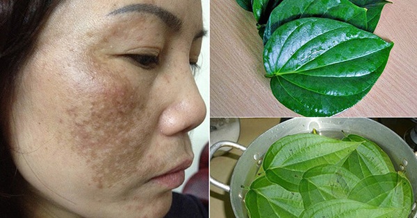 How to treat melasma with betel leaf?