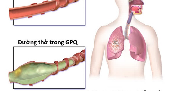 Những biến chứng nguy hiểm có thể xảy ra từ bệnh giãn phế quản ho ra máu?
