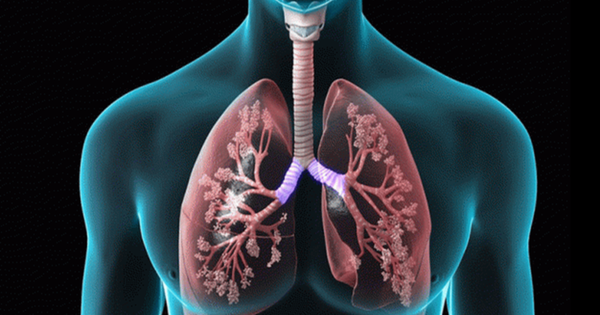 Những yếu tố góp phần vào việc phát triển xơ phổi sau covid là gì?
