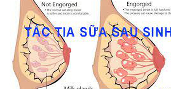 20 bài thuốc trị tắc tia sữa, mẹ bỉm sữa cần biết