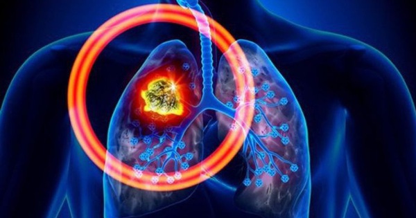 Những yếu tố di truyền nào có thể đóng vai trò trong gây ra ung thư phổi?
