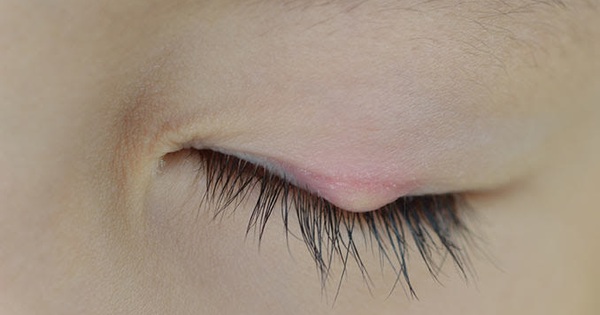Có những phương pháp tự nhiên nào giúp hỗ trợ việc điều trị lẹo mắt tái phát ở trẻ em?
