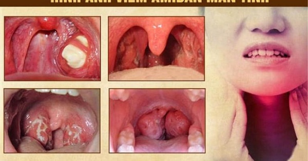 Tác nhân gây ra viêm amidan mạn là gì?
