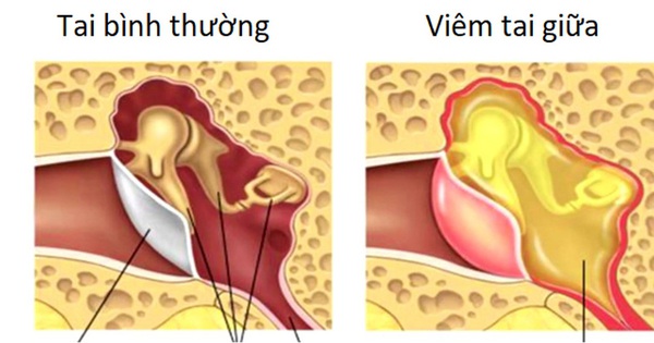 Quá trình viêm tai giữa mãn tính thủng nhĩ diễn ra như thế nào? 
