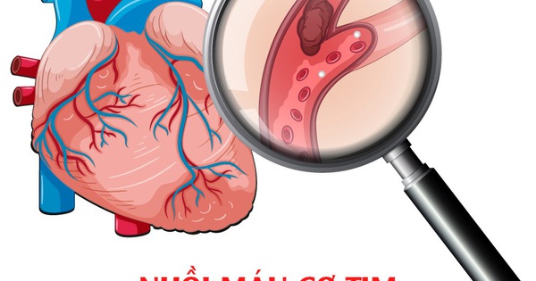 Làm thế nào để phòng tránh đột quỵ nhồi máu cơ tim?

