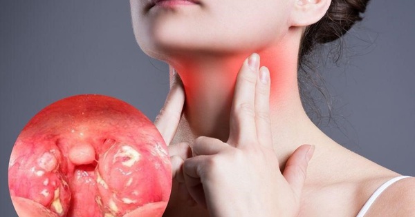 Cách ngăn ngừa vi khuẩn gây đau họng sưng amidan?
