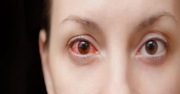 Viêm mắt có thể xảy ra trước các triệu chứng khác của COVID-19 hay không?
