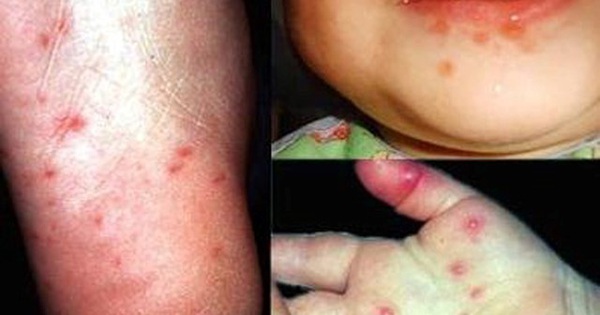 Bệnh chân tay miệng gây ra những triệu chứng gì ở trẻ?
