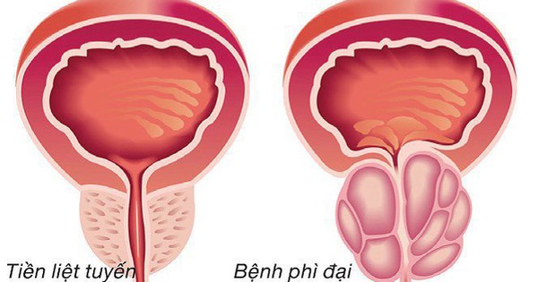 Có những phản ứng phụ nào có thể xảy ra khi sử dụng thảo dược chữa phì đại tiền liệt tuyến?
