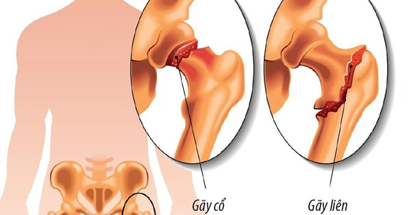thumbnail - Gãy cổ xương đùi - Chấn thương nguy hiểm nhất ở người cao tuổi