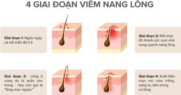 Có những tác dụng phụ nào mà thuốc điều trị viêm nang lông có thể gây ra?
