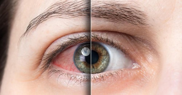 thumbnail - Chăm sóc mắt, tránh các bệnh về mắt mùa nắng nóng