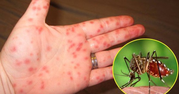 10 dấu hiệu bệnh sốt xuất huyết sắp khỏi bạn cần biết để phòng tránh tái phát