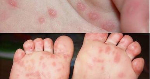Virus gây ra bệnh chân tay miệng là loại virus nào? 

