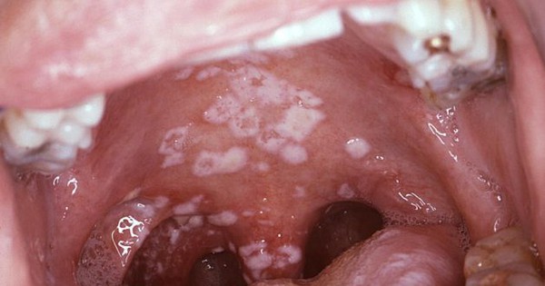 Liệu nấm miệng có thể ảnh hưởng đến sức khỏe tổng thể không? 
