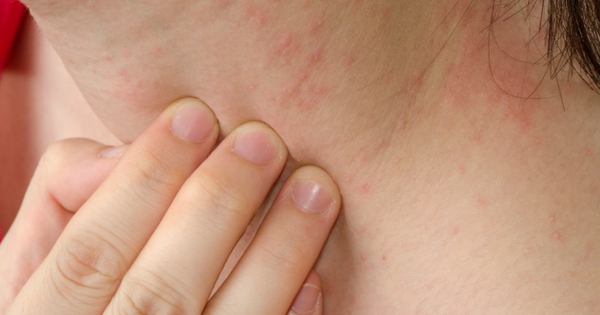 What are the causes and treatment options for người nóng nổi mẩn ngứa (itchy rash in hot-tempered individuals)?