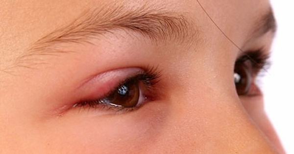 Có những liệu pháp truyền thống hoặc hiện đại nào để điều trị ngứa mắt dị ứng?
