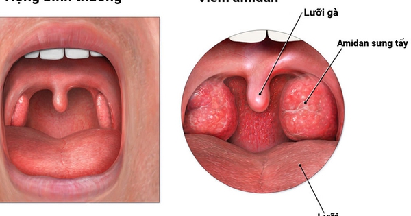 Tại sao viêm amidan kéo dài có thể gây khó thở?
