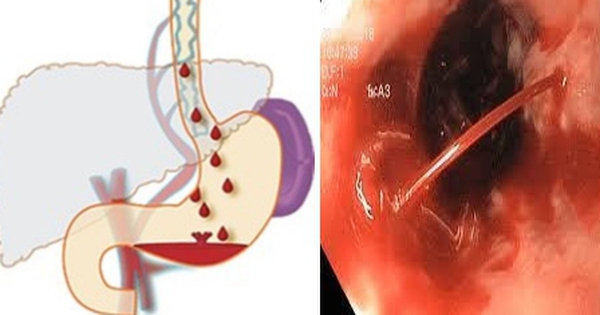 Phương pháp chẩn đoán giãn tĩnh mạch thực quản độ 3 là gì?
