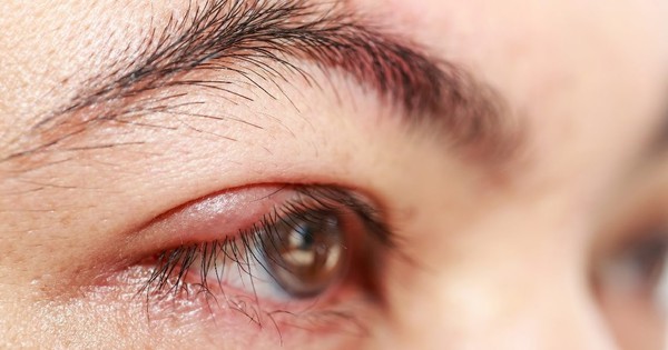 Nếu bị nhiễm trùng mắt, cần điều trị như thế nào?
