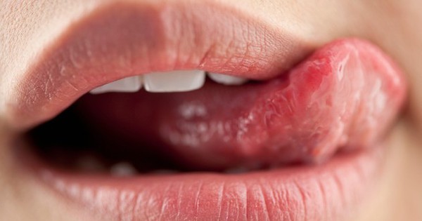 Có cách nào để làm giảm đau và khó chịu do viêm da quanh miệng không?

